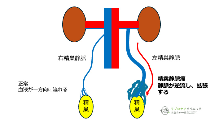 精索静脈瘤解剖図